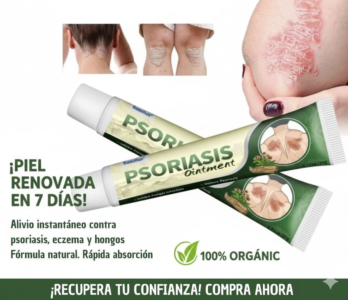 ✅ PSORIASIS™ |  Alivia la picazón y el enrojecimiento de la piel desde la primera aplicación ☀️